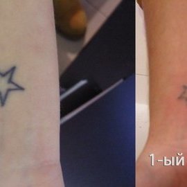 Выведение татуировки 